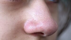 બ્લેકહેડ્સ