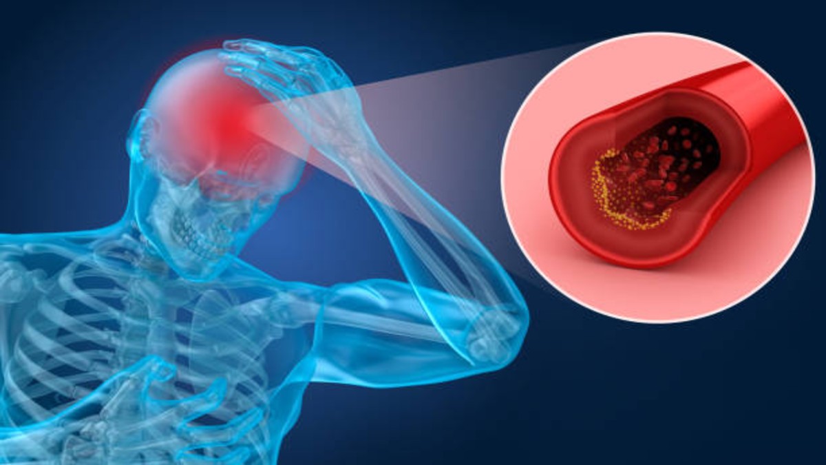 Brain Hemorrhage