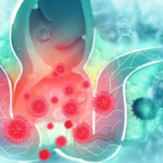 Piles Treatment and Causes