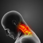 Cervical Spondylosis Symptoms
