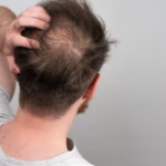 Male Pattern Baldness Causes