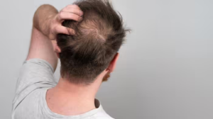 Male Pattern Baldness Causes