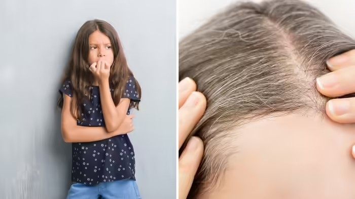 Premature hair greying